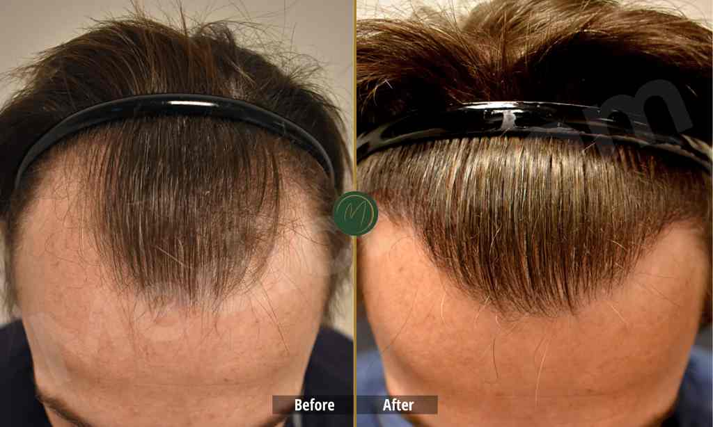 Hair transplant before