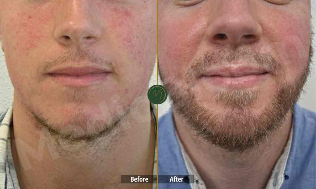 Beard Hair Transplantation in Dubai
