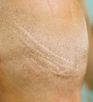 Hair Transplantation Scars & Burn Wounds